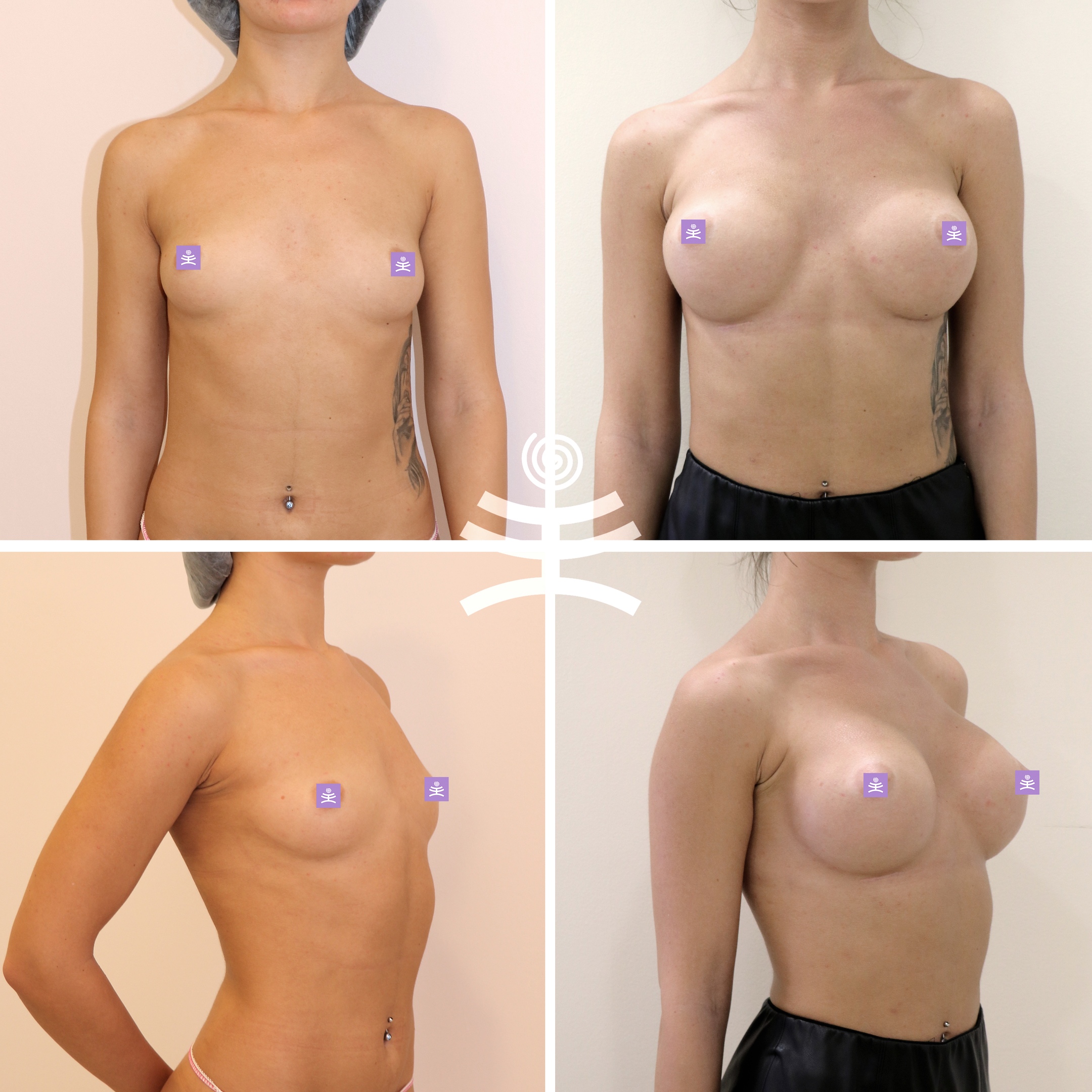Xxx A Fake Tits Implants Silicone Pierced Navel Hard Nipples Erect