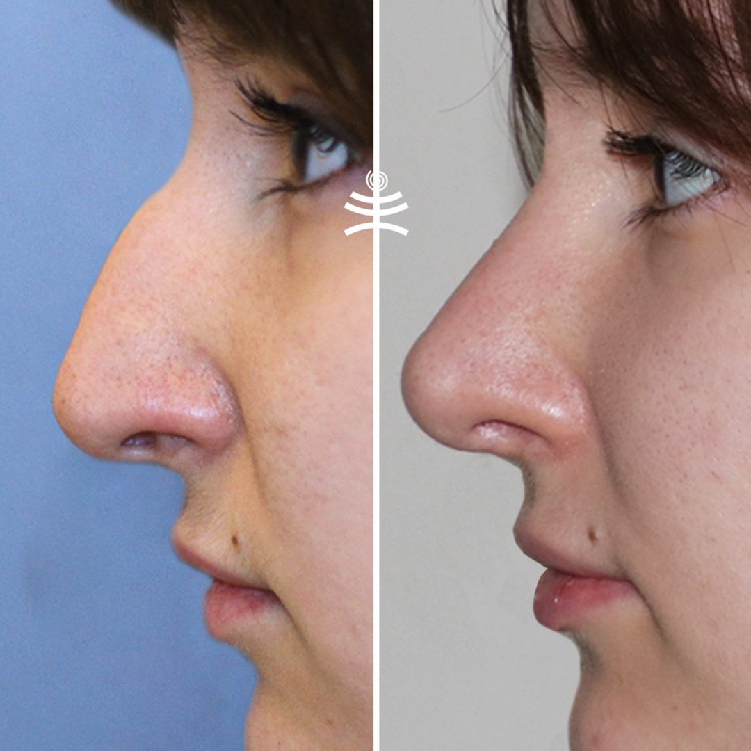 ринопластика носа фото после операции